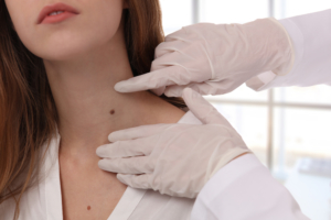 An esthetician wearing gloves examines a beauty mark on a woman's neck